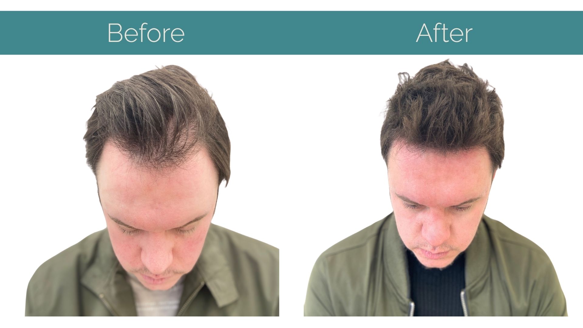 Before and After surgery