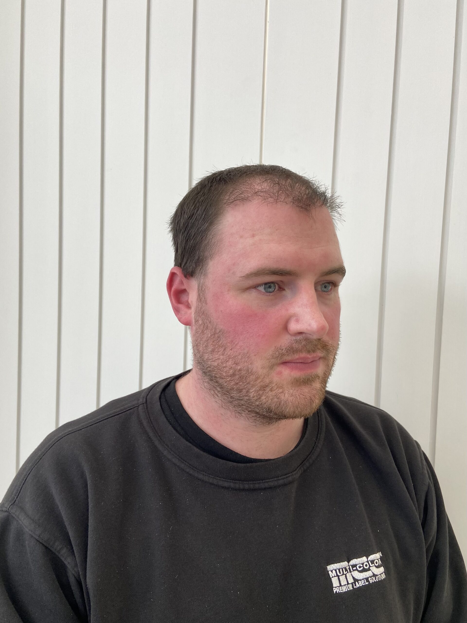 Before hair transplant - receeding hairlne on a man