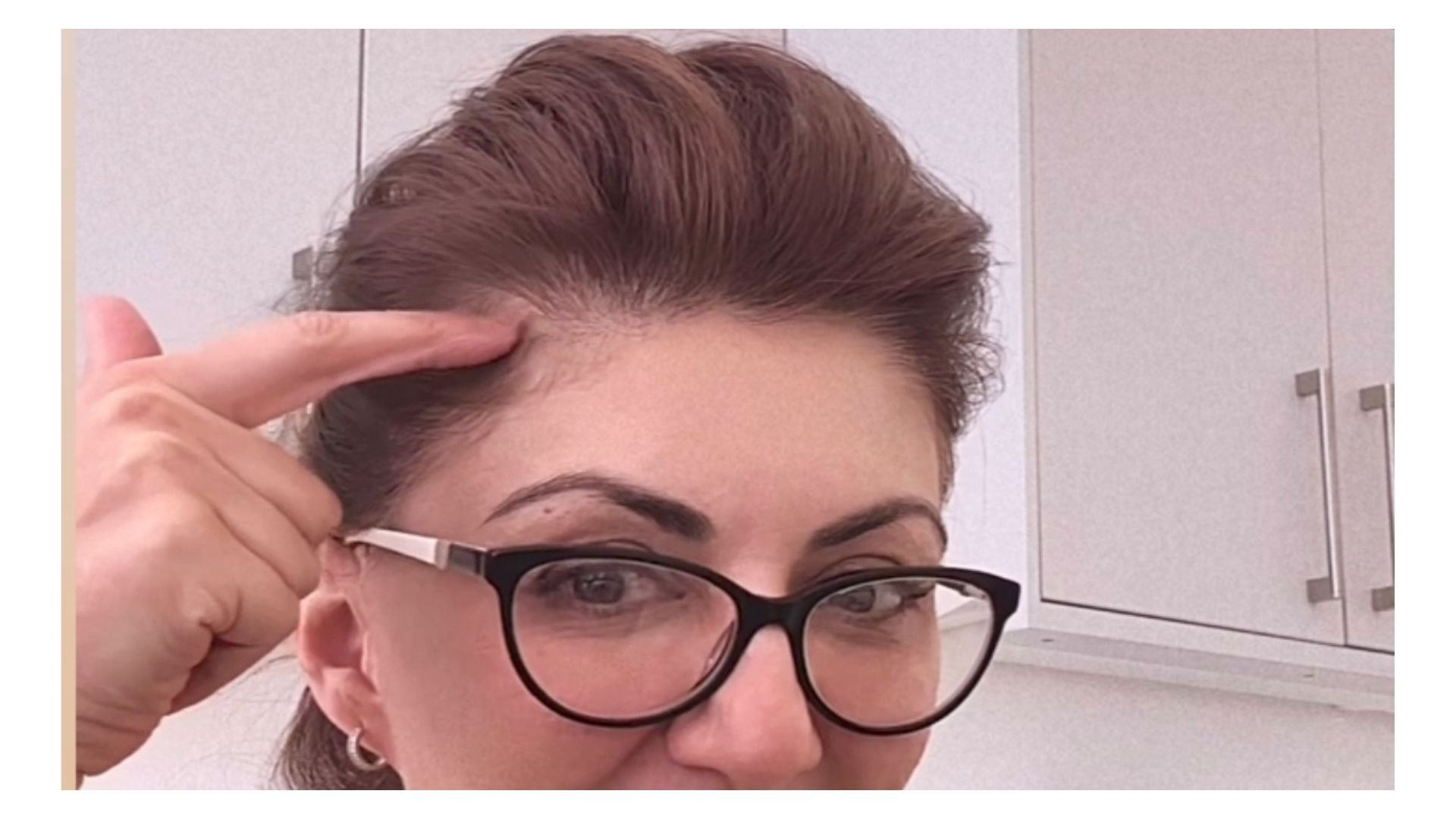 Irum showing Hair Thinning