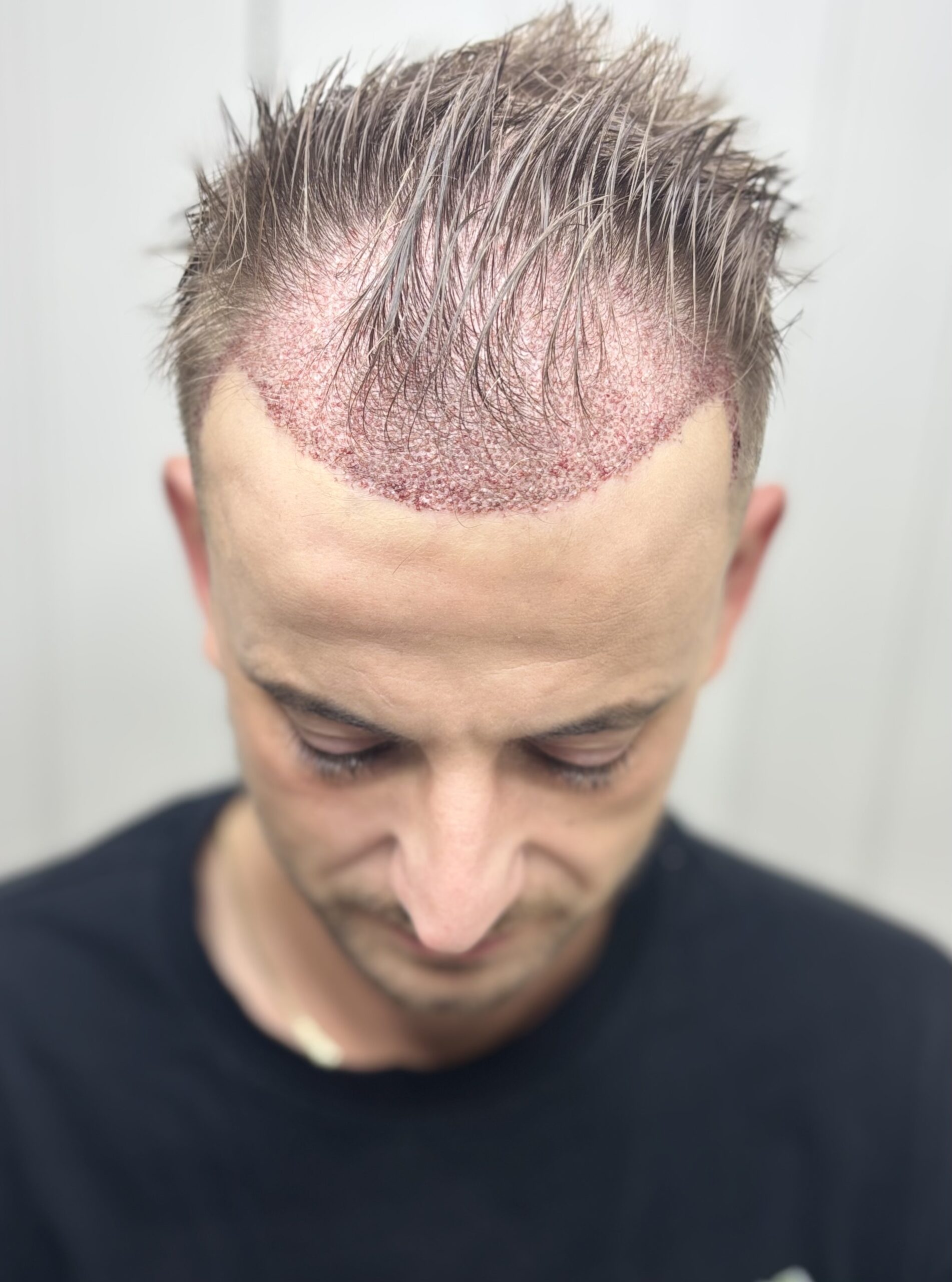 2000 hair follicles for hairline restoration