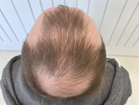 Before Transplant 1.1 on client
