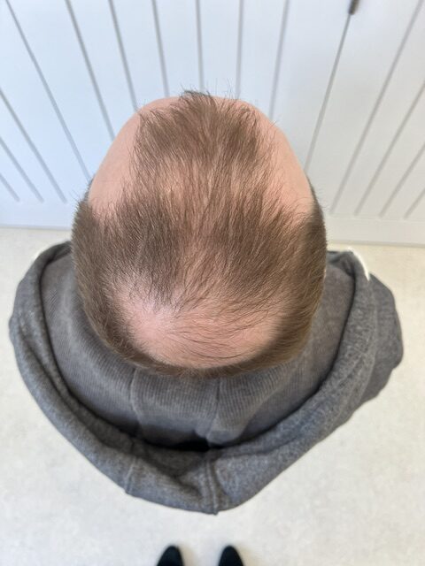 Before Transplant 1.1 on client
