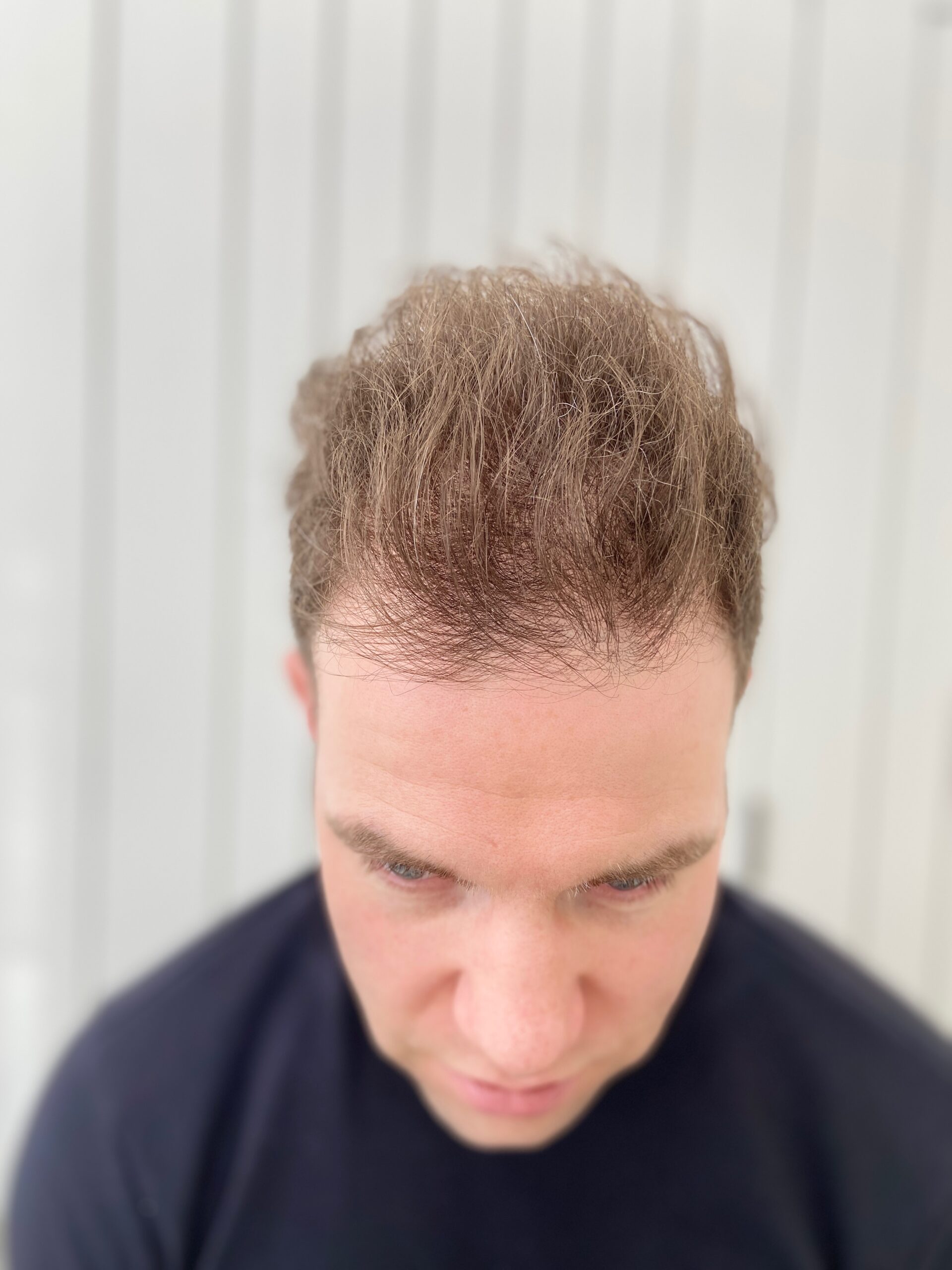 Male with thinning hair line