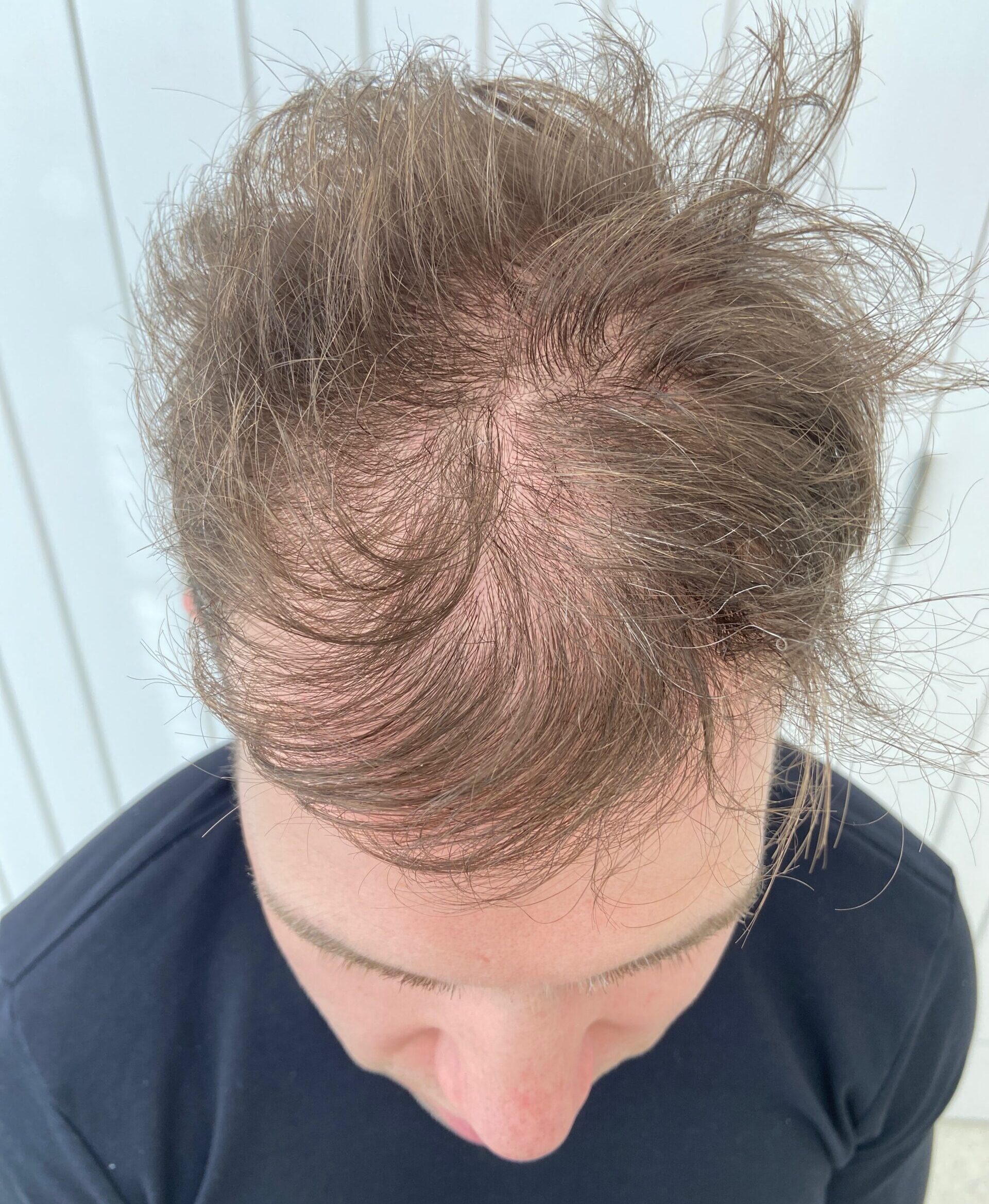 Client showing signs of hair thinning and loss