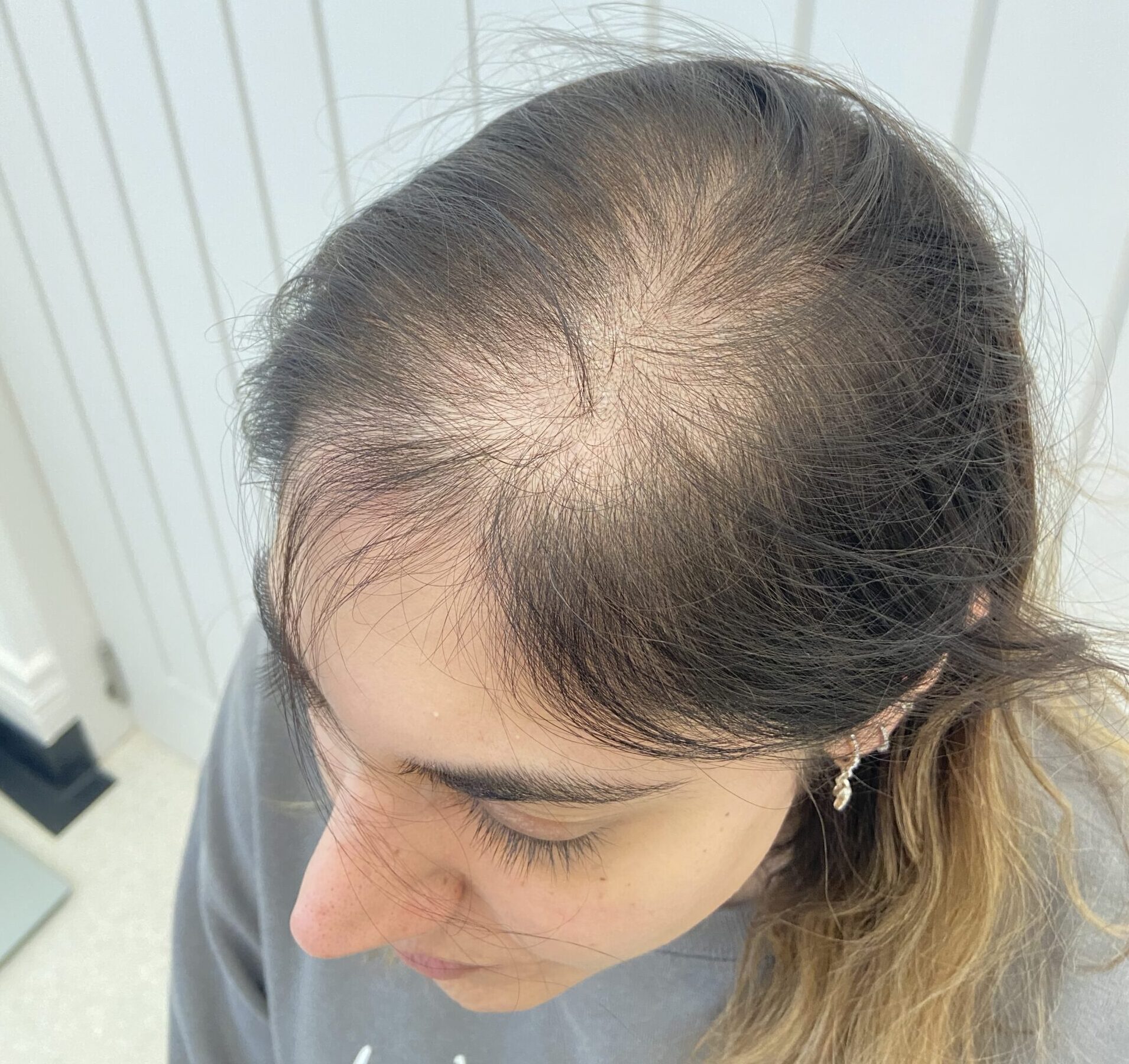 Image of a female client with a thinning hair parting