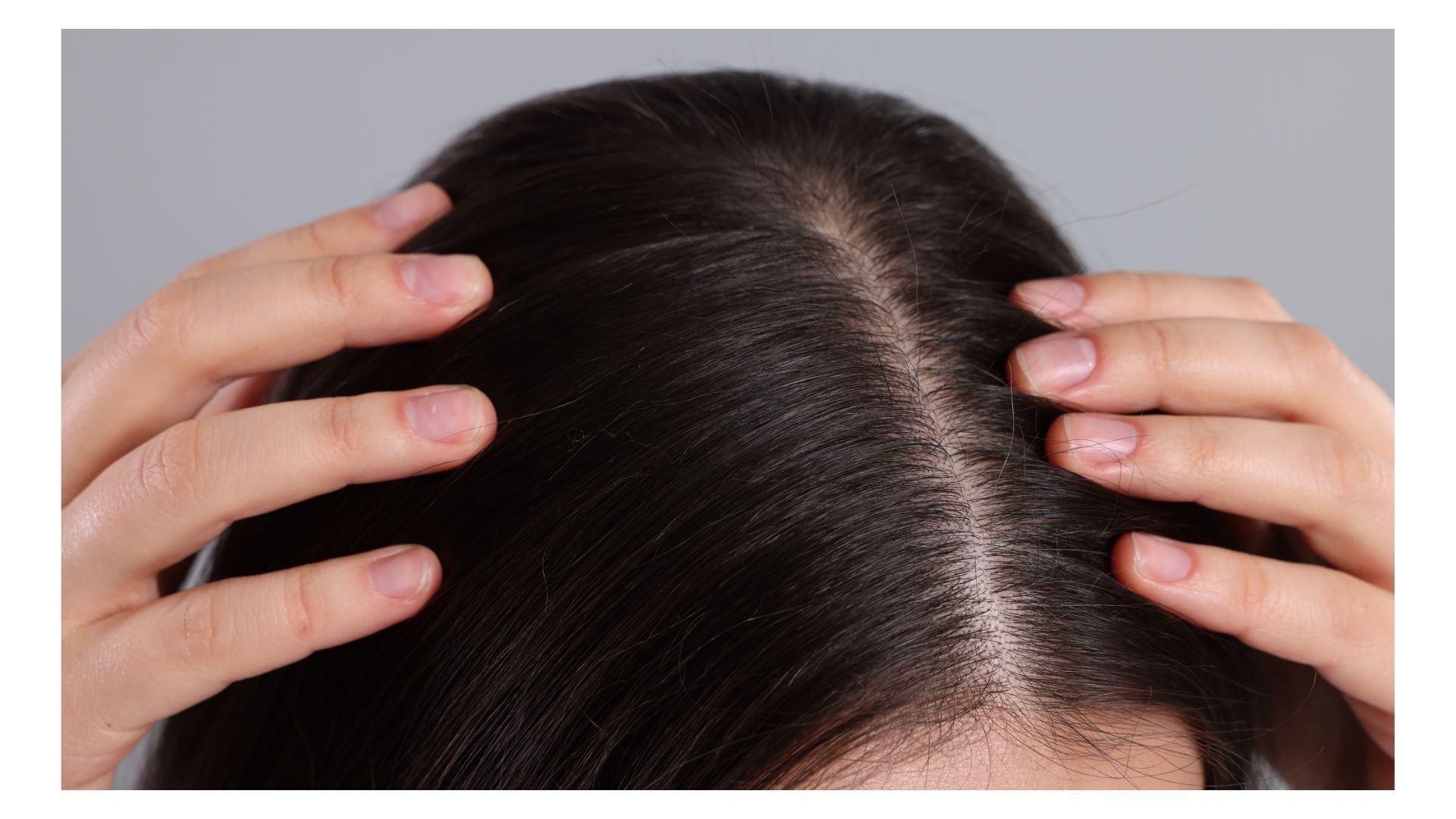 Thinning Hair